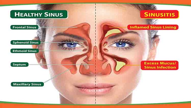 sinsus infection