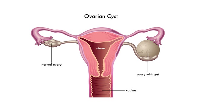 ovary-cyst
