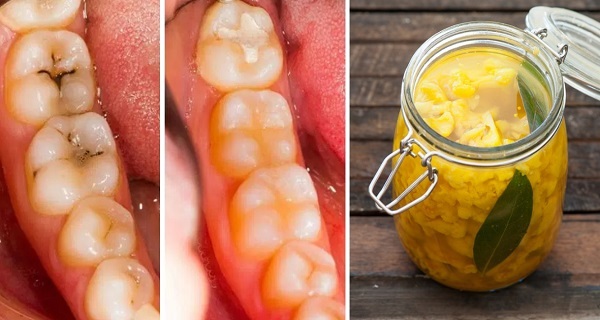How-to-Heal-Tooth-Decay-Cavities-Naturally-With-3-Simple-and-Effective-Home-Remedies