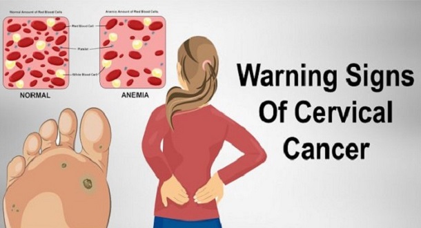 Never-Ignore-These-7-Signs-Of-Cervical-Cancer. 